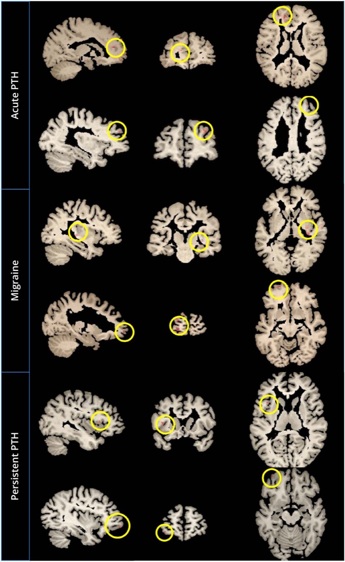 Grad-CAM peak activation regions circled on sagittal, coronal and axial T1 slices for acute PTH, migraine and persistent PTH participants